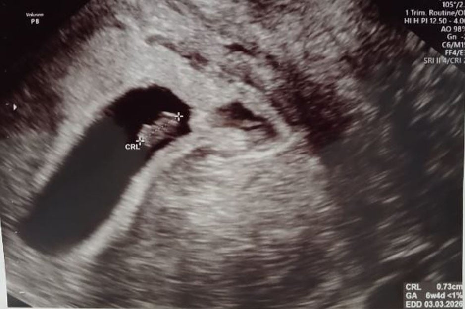 Hukum Aqiqah untuk Janin Keguguran  – Portal Islam